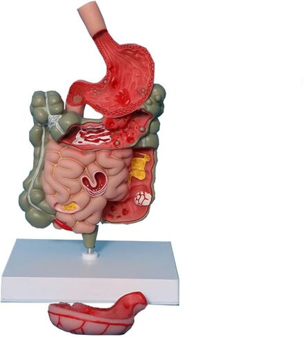 Human Stomach Anatomy Model Pathological Digestive System Model, Removerable Teaching Model,Stomach Section Large Small Intestine Medical Model Anatomy in Kuwait