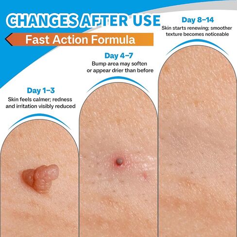 Molluscum Support Treatment, Molluscum Support Cream All Natural Support Cream for Molluscum Rash, SALICYLIC Acid 10% in Kuwait