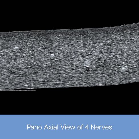 نموذج تدريب فانتوم بالموجات فوق الصوتية للممارسة الطبية، محاكاة إحصار العصب (نموذج العصب) in Kuwait