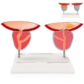 Prostate Pathological Anatomy Model - Male Urinary Reproductive System Model,Male Reproductive System Educational Model,Detachable 3D Prostate with BPH and Cancer for Medical Teaching in Kuwait