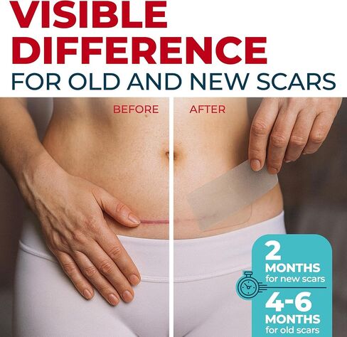 شريط ندبات من السيليكون الطبي - 1.6 بوصة × 70 بوصة - إزالة فعالة للندبات الجراحية، والجُدرات، والقسم القيصري، وشد البطن، والندبات الضخامية وحب الشباب - علاج سهل الاستخدام - أوراق ندبات السيليكون القابلة لإعادة الاستخدام in Kuwait