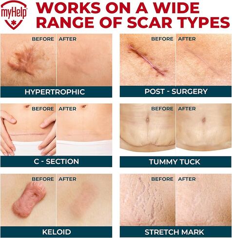 شريط ندبات من السيليكون الطبي - 1.6 بوصة × 70 بوصة - إزالة فعالة للندبات الجراحية، والجُدرات، والقسم القيصري، وشد البطن، والندبات الضخامية وحب الشباب - علاج سهل الاستخدام - أوراق ندبات السيليكون القابلة لإعادة الاستخدام in Kuwait