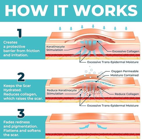 شريط ندبات من السيليكون الطبي - 1.6 بوصة × 70 بوصة - إزالة فعالة للندبات الجراحية، والجُدرات، والقسم القيصري، وشد البطن، والندبات الضخامية وحب الشباب - علاج سهل الاستخدام - أوراق ندبات السيليكون القابلة لإعادة الاستخدام in Kuwait