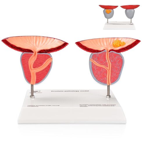 Prostate Pathological Anatomy Model - Male Urinary Reproductive System Model,Male Reproductive System Educational Model,Detachable 3D Prostate with BPH and Cancer for Medical Teaching in Kuwait