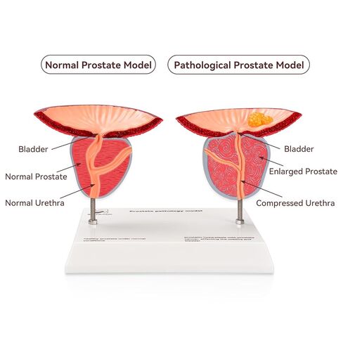 Prostate Pathological Anatomy Model - Male Urinary Reproductive System Model,Male Reproductive System Educational Model,Detachable 3D Prostate with BPH and Cancer for Medical Teaching in Kuwait