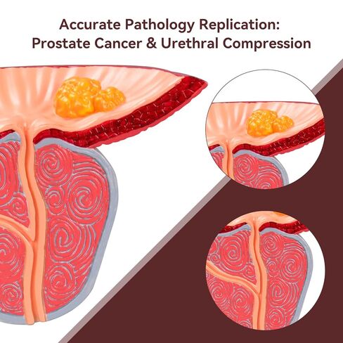 Prostate Pathological Anatomy Model - Male Urinary Reproductive System Model,Male Reproductive System Educational Model,Detachable 3D Prostate with BPH and Cancer for Medical Teaching in Kuwait