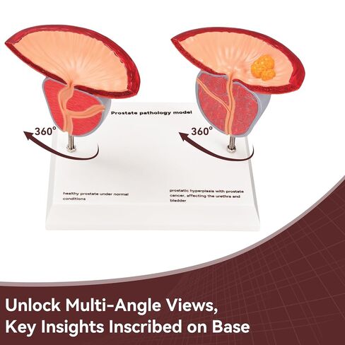 Prostate Pathological Anatomy Model - Male Urinary Reproductive System Model,Male Reproductive System Educational Model,Detachable 3D Prostate with BPH and Cancer for Medical Teaching in Kuwait