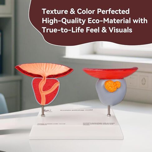 Prostate Pathological Anatomy Model - Male Urinary Reproductive System Model,Male Reproductive System Educational Model,Detachable 3D Prostate with BPH and Cancer for Medical Teaching in Kuwait