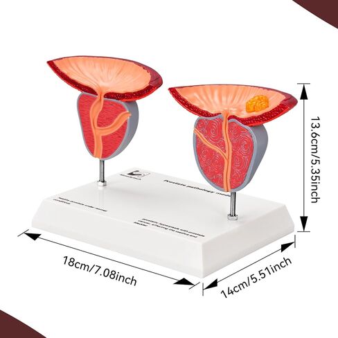 Prostate Pathological Anatomy Model - Male Urinary Reproductive System Model,Male Reproductive System Educational Model,Detachable 3D Prostate with BPH and Cancer for Medical Teaching in Kuwait