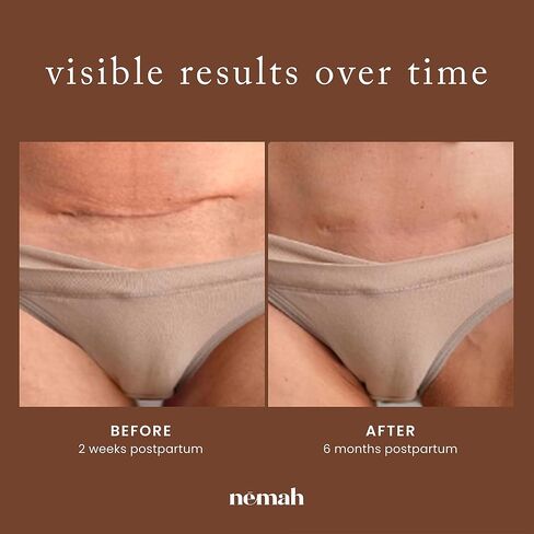 Nemah Restorative Scar Treatment, C Section Recovery, Scar Cream for Surgical Scars, Ideal to Reduce the C Section and Acne Marks, Dermatologist Approved, Antioxidant Rich, Vegan Formula, 1 oz in Kuwait