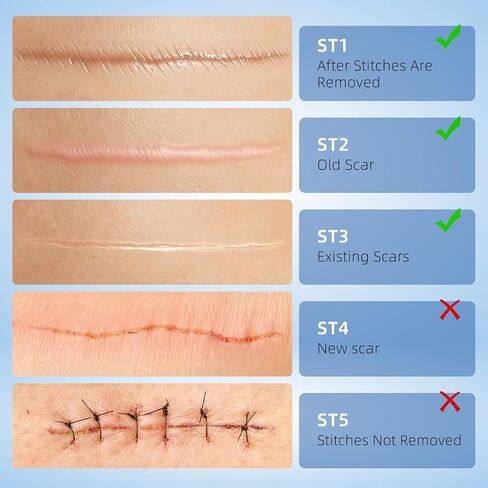Silicone Scar Gel for Old and New Scars, Stretch Marks & Acne Scar Removal, Advanced Silicone Scar Cream for Surgical, Burn, Keloid, Injury & Acne Scars, Fast Absorbing Gel, 1.76 oz (50ml) in Saudi Arabia