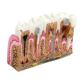 Dental Tooth Model Caries Tooth Anatomy Model Dental Problems Oral Comprehensive Teaching Teeth Model for Students in Kuwait