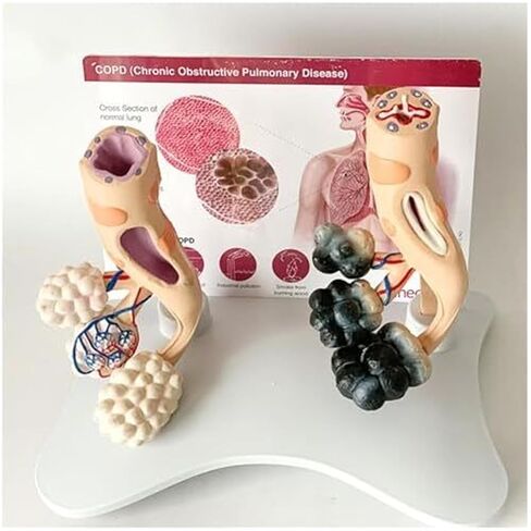 Human Alveolar Model, Comparative Model of Health and Pathology, and Enlarged Structure for Learning Display Teaching in Saudi Arabia