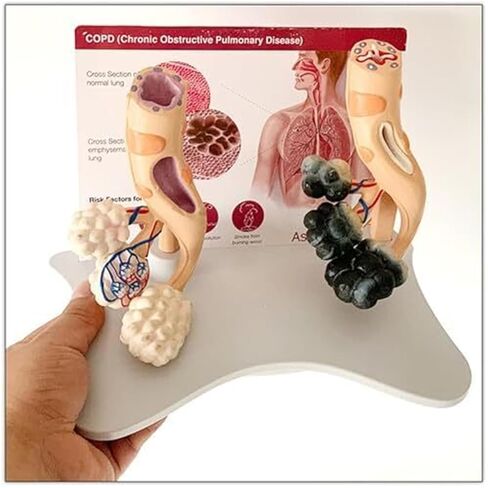 Human Alveolar Model, Comparative Model of Health and Pathology, and Enlarged Structure for Learning Display Teaching in Saudi Arabia