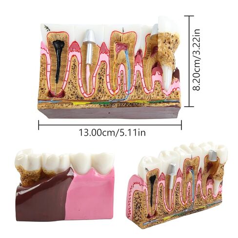 Dental Tooth Model Caries Tooth Anatomy Model Dental Problems Oral Comprehensive Teaching Teeth Model for Students in Kuwait