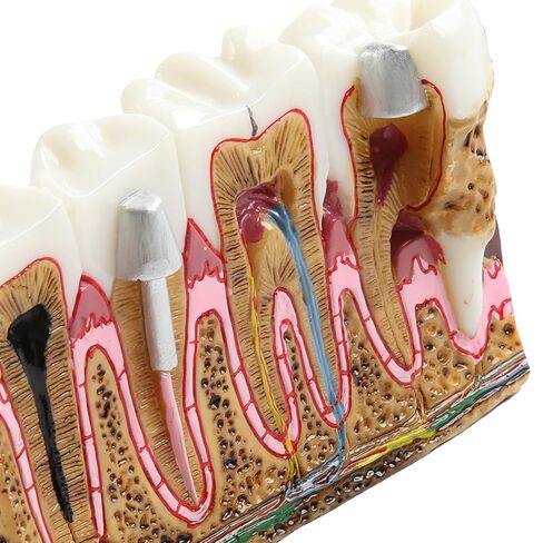 Dental Tooth Model Caries Tooth Anatomy Model Dental Problems Oral Comprehensive Teaching Teeth Model for Students in Kuwait
