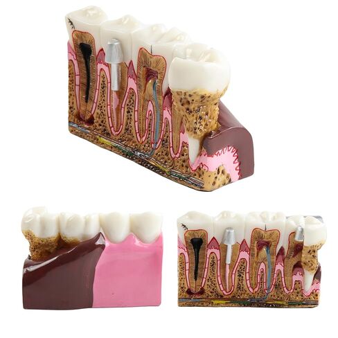 Dental Tooth Model Caries Tooth Anatomy Model Dental Problems Oral Comprehensive Teaching Teeth Model for Students in Kuwait