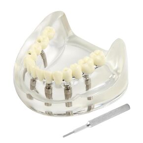 Dental Implant Model Transparent Upper Jaw with 6 Implants and Removable Screws for Overdenture Restoration Dental School Teaching Lab Demo and Patient Education in Kuwait