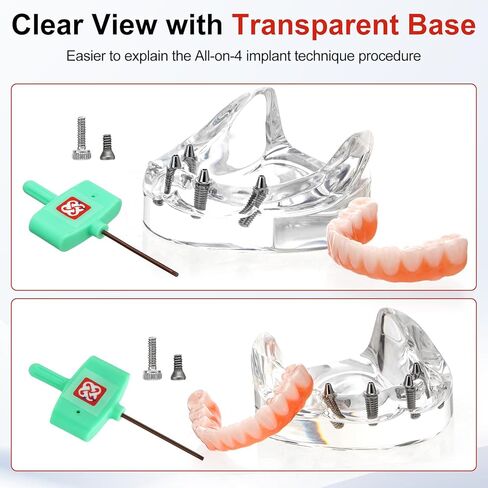 PER4MANCE All-on-4 Dental Implant Model: Includes Upper and Lower Jaw with Transparent Base, Removable Crowns for Educational Demonstration in Kuwait