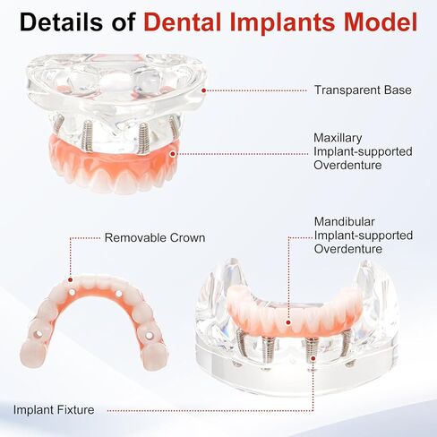 PER4MANCE All-on-4 Dental Implant Model: Includes Upper and Lower Jaw with Transparent Base, Removable Crowns for Educational Demonstration in Kuwait