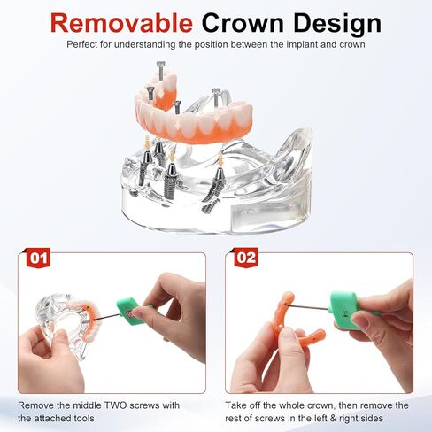 PER4MANCE All-on-4 Dental Implant Model: Includes Upper and Lower Jaw with Transparent Base, Removable Crowns for Educational Demonstration in Kuwait