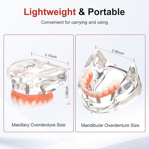 PER4MANCE All-on-4 Dental Implant Model: Includes Upper and Lower Jaw with Transparent Base, Removable Crowns for Educational Demonstration in Kuwait