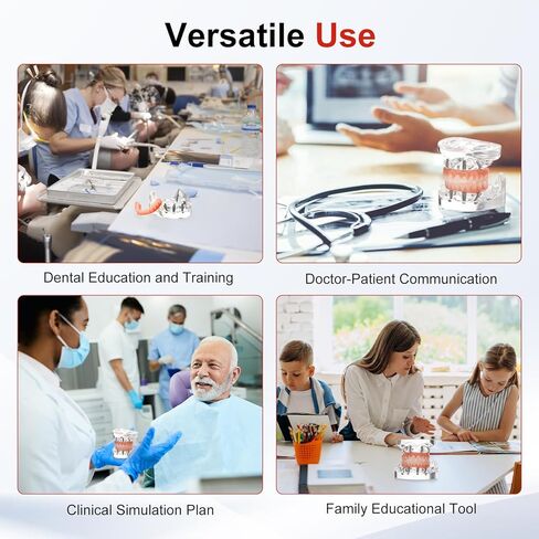 PER4MANCE All-on-4 Dental Implant Model: Includes Upper and Lower Jaw with Transparent Base, Removable Crowns for Educational Demonstration in Kuwait