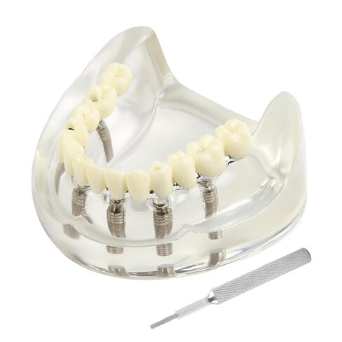 Dental Implant Model Transparent Upper Jaw with 6 Implants and Removable Screws for Overdenture Restoration Dental School Teaching Lab Demo and Patient Education in Kuwait