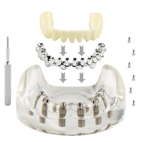 Dental Implant Model Transparent Upper Jaw with 6 Implants and Removable Screws for Overdenture Restoration Dental School Teaching Lab Demo and Patient Education in Kuwait