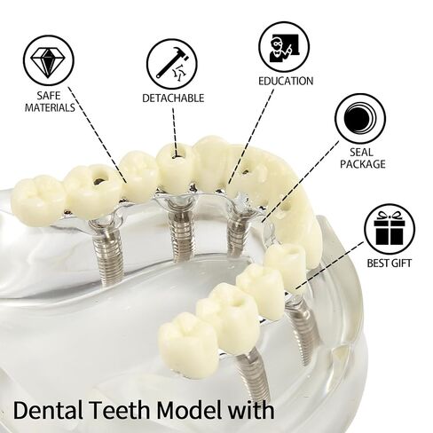 Dental Implant Model Transparent Upper Jaw with 6 Implants and Removable Screws for Overdenture Restoration Dental School Teaching Lab Demo and Patient Education in Kuwait