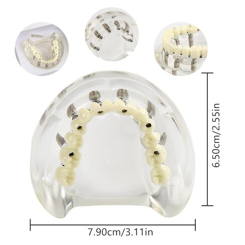 Dental Implant Model Transparent Upper Jaw with 6 Implants and Removable Screws for Overdenture Restoration Dental School Teaching Lab Demo and Patient Education in Kuwait