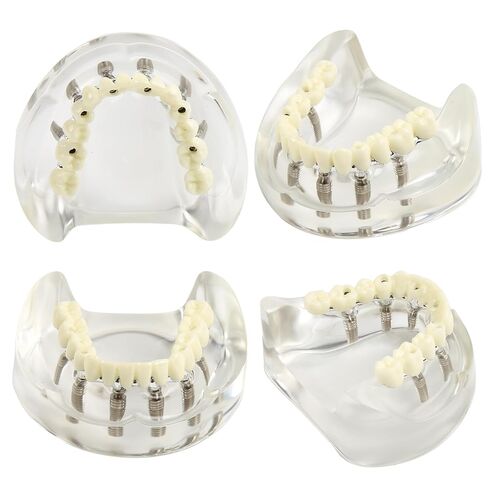 Dental Implant Model Transparent Upper Jaw with 6 Implants and Removable Screws for Overdenture Restoration Dental School Teaching Lab Demo and Patient Education in Kuwait
