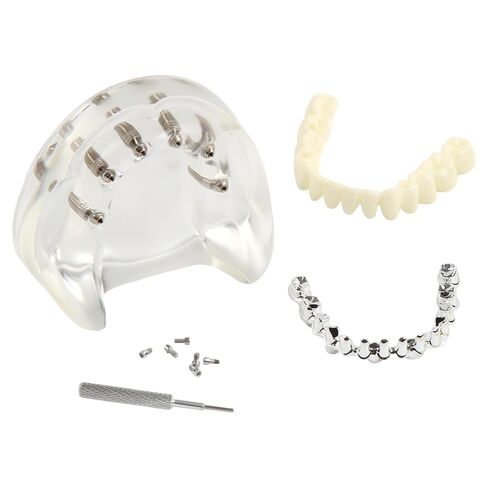 Dental Implant Model Transparent Upper Jaw with 6 Implants and Removable Screws for Overdenture Restoration Dental School Teaching Lab Demo and Patient Education in Kuwait
