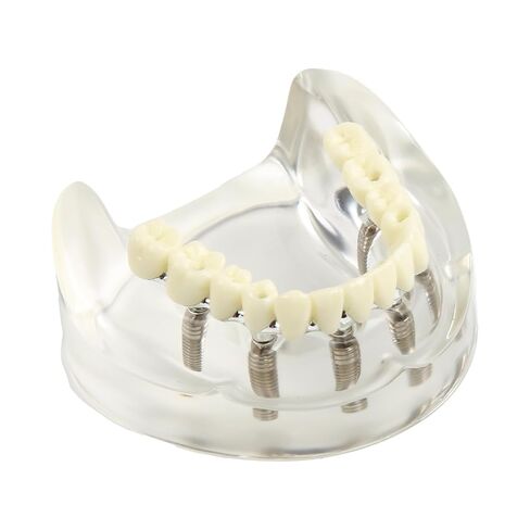Dental Implant Model Transparent Upper Jaw with 6 Implants and Removable Screws for Overdenture Restoration Dental School Teaching Lab Demo and Patient Education in Kuwait