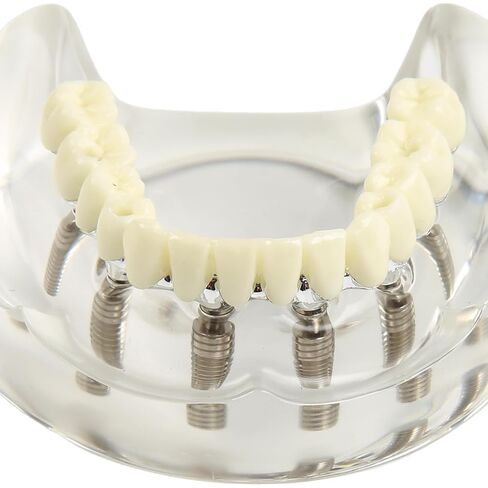 Dental Implant Model Transparent Upper Jaw with 6 Implants and Removable Screws for Overdenture Restoration Dental School Teaching Lab Demo and Patient Education in Kuwait