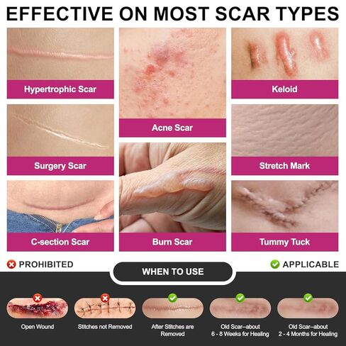 صفائح ندبة من السيليكون، شريط ندبات من السيليكون الطبي للندبات الجراحية، شريط سيليكون بعرض 1.77 بوصة × 120 بوصة، شريط سيليكون أوسع 3 أمتار لندبات الجدرة، الضخامية، القسم القيصري، شد البطن، بقع الجراحة وندبات الحروق in Kuwait