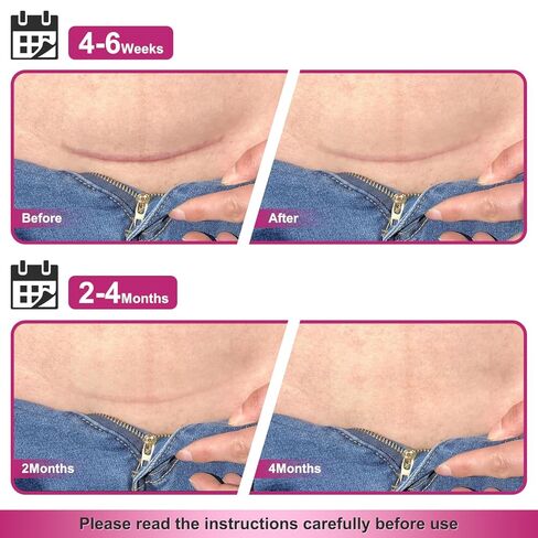 صفائح ندبة من السيليكون، شريط ندبات من السيليكون الطبي للندبات الجراحية، شريط سيليكون بعرض 1.77 بوصة × 120 بوصة، شريط سيليكون أوسع 3 أمتار لندبات الجدرة، الضخامية، القسم القيصري، شد البطن، بقع الجراحة وندبات الحروق in Kuwait