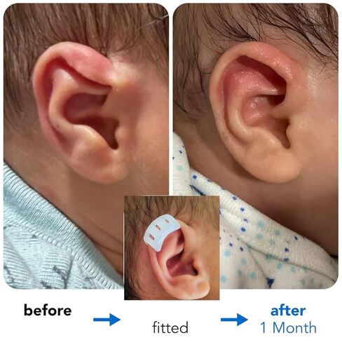 Infant Lop Ear Deformity Correction Clip For Newborn Baby, Fixing Auricle Valgus Patch Stickers Children Ear Shape Aesthetic Corrector Without Surgery in Saudi Arabia