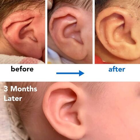 Infant Lop Ear Deformity Correction Clip For Newborn Baby, Fixing Auricle Valgus Patch Stickers Children Ear Shape Aesthetic Corrector Without Surgery in Saudi Arabia