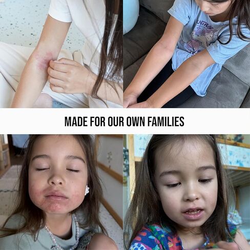 رذاذ إصلاح البشرة هيبوكلوروس من كيتش، رذاذ الإسعافات الأولية لعلاج الأكزيما، علاج الجلد الجاف، مسح التنظيف قبل كريم الأكزيما، غسول الجسم والوجه الحساس، تخفيف الحكة in Kuwait