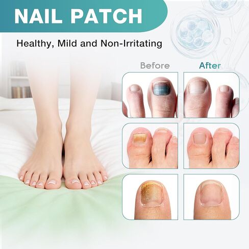 Fungal Nail Patches, Toenail Fungus Treatment Extra Strength - 20 Fungal Nail Patches for Toe Nail Fungus Treatments, 8-Hour Nighttime Nail Fungus Patches for Nail Fungus Treatment in Kuwait