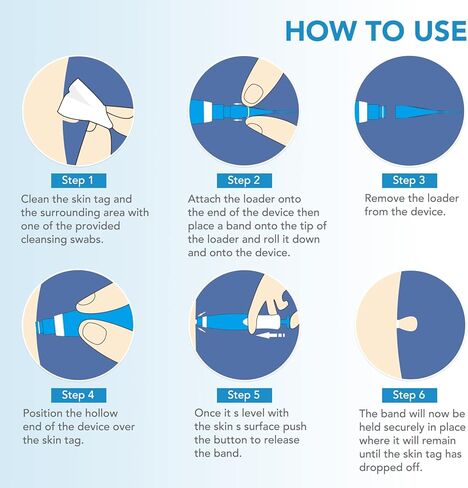 جهاز إزالة الزوائد الجلدية، مجموعة آمنة وفعالة لإزالة الزوائد الجلدية، حاصلة على موافقة إدارة الأغذية والعقاقير (FDA)، للاستخدام المنزلي in Kuwait