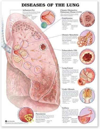 أمراض ACC في الرسم البياني التشريحي للرئة in Kuwait