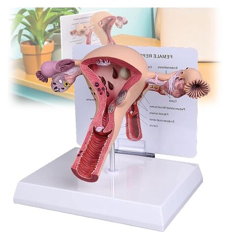 Female Reproductive Organ Model, Pathological Uterus and Ovary, Used As A Demonstration Tool for School Teaching in Kuwait