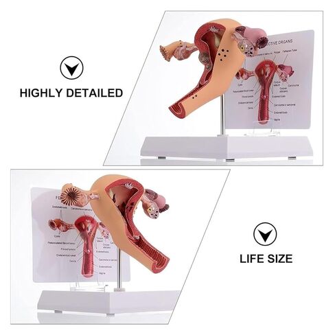 Female Reproductive Organ Model, Pathological Uterus and Ovary, Used As A Demonstration Tool for School Teaching in Kuwait