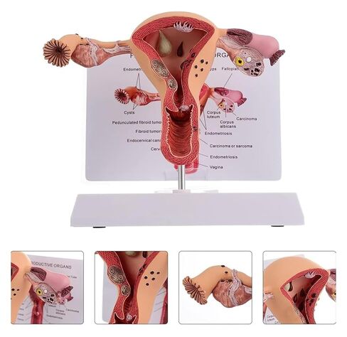 Female Reproductive Organ Model, Pathological Uterus and Ovary, Used As A Demonstration Tool for School Teaching in Kuwait