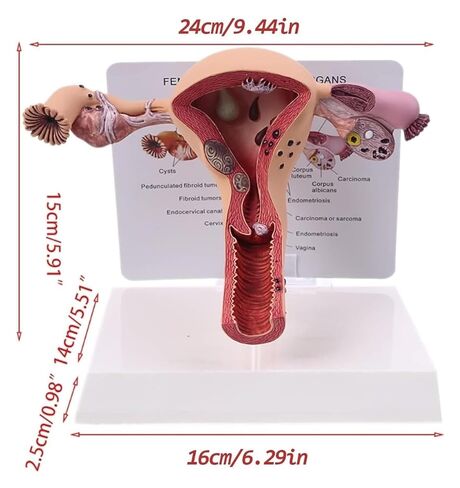 Female Reproductive Organ Model, Pathological Uterus and Ovary, Used As A Demonstration Tool for School Teaching in Kuwait