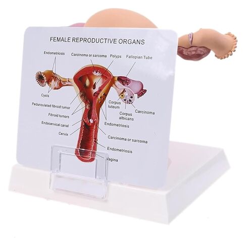 Female Reproductive Organ Model, Pathological Uterus and Ovary, Used As A Demonstration Tool for School Teaching in Kuwait