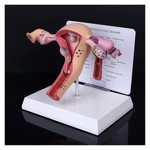 Female Reproductive Organ Model, Pathological Uterus and Ovary, Used As A Demonstration Tool for School Teaching in Kuwait