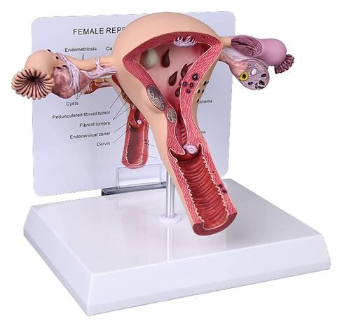 Female Reproductive Organ Model, Pathological Uterus and Ovary, Used As A Demonstration Tool for School Teaching in Kuwait